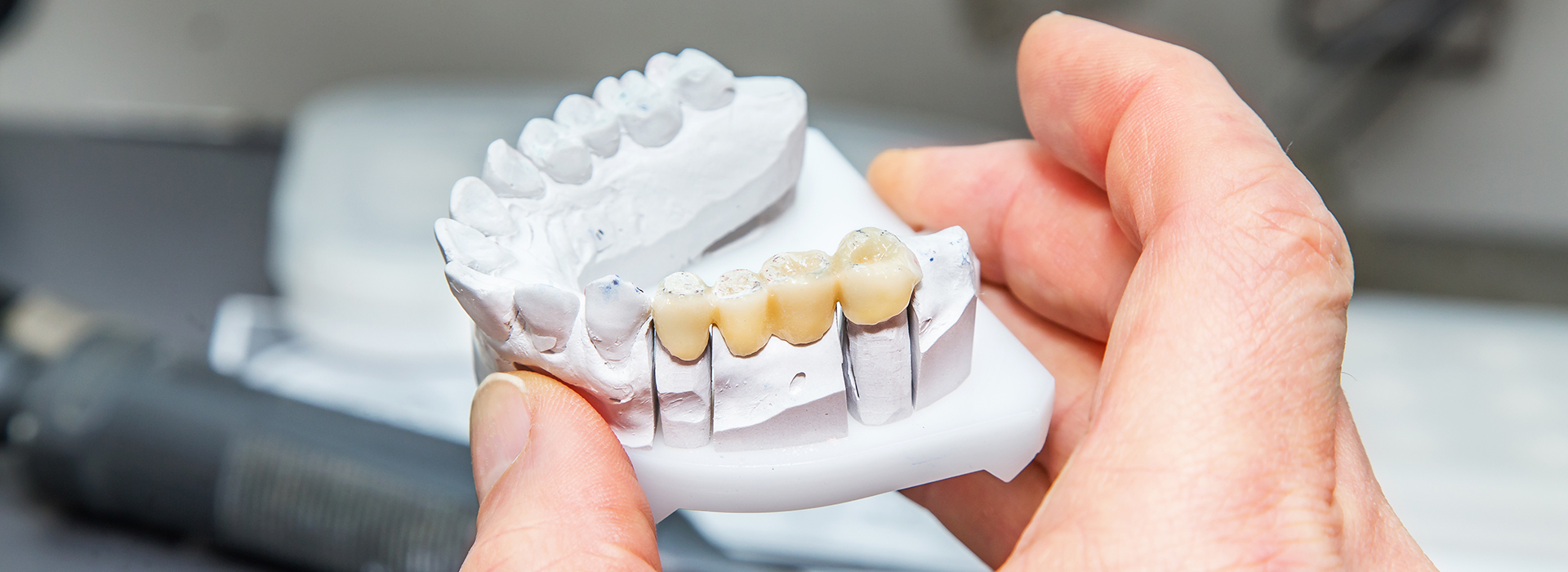 iSmile Dental | Implant Restorations, All-on-4 reg  and All-on-6 reg 