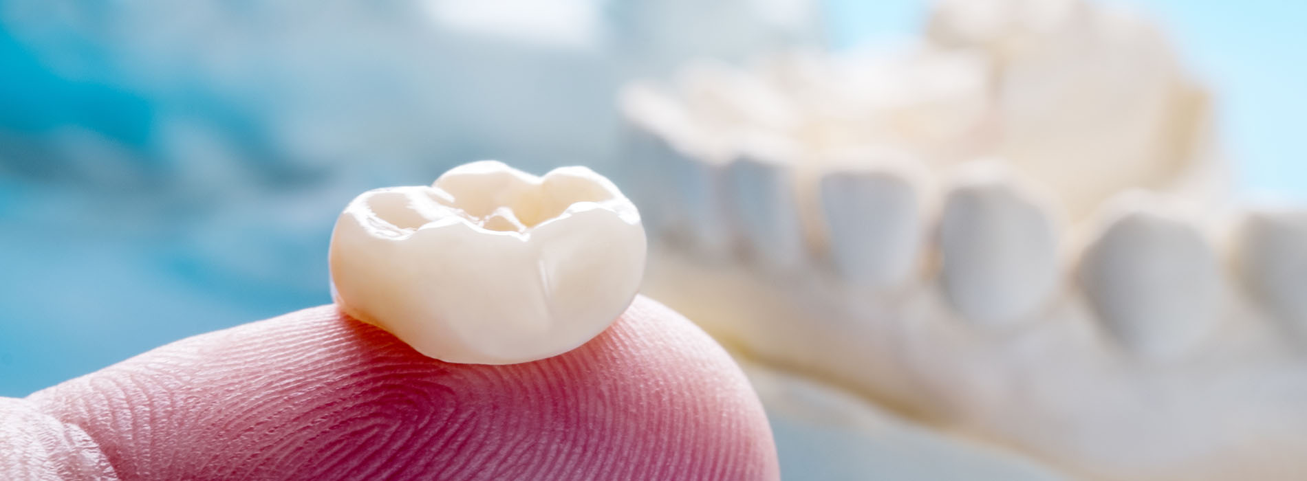 iSmile Dental | Dental Bridges, Teeth Whitening and Implant Dentistry