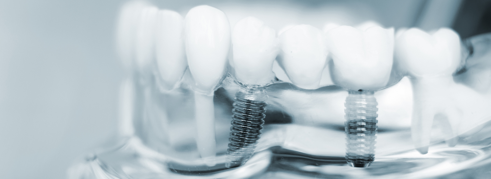 iSmile Dental | Digital Impressions, Root Canals and Oral Exams